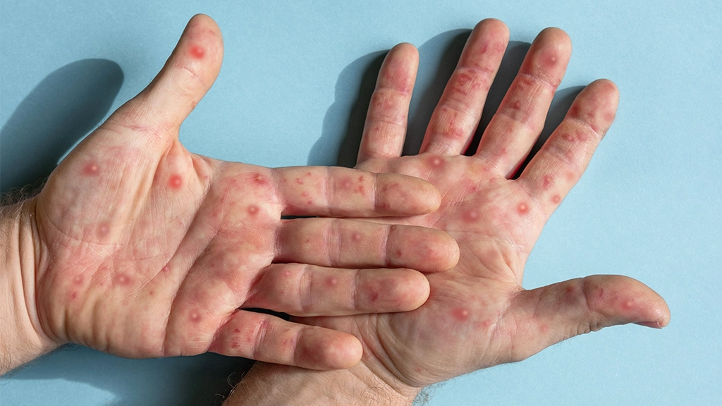 Mpox: número de casos confirmados no Brasil sobe para 140 em 2026