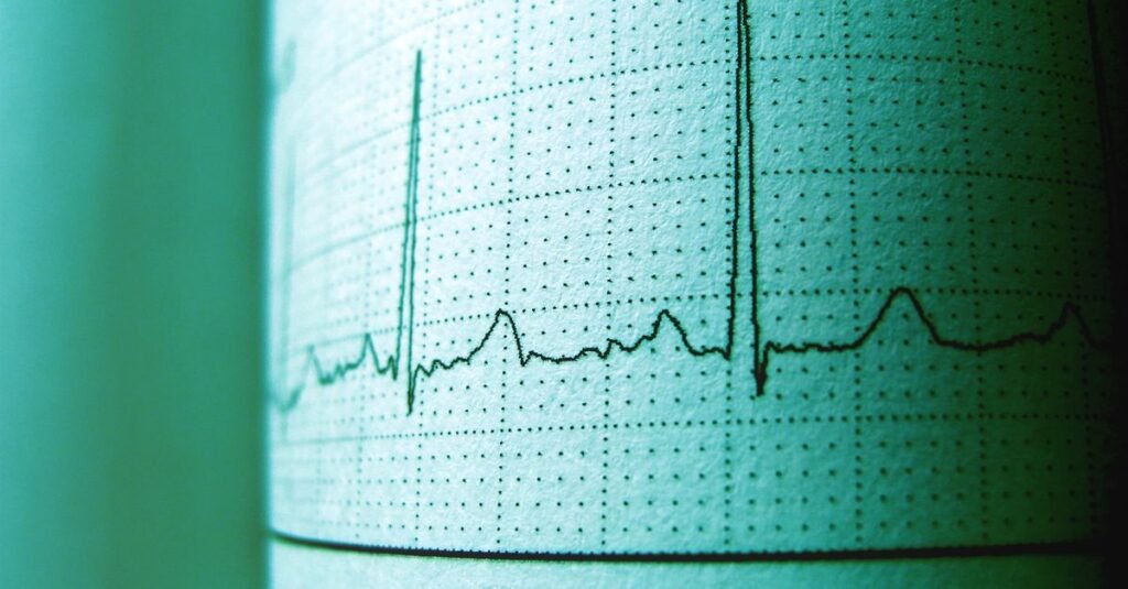 Traçado de eletrocardiograma impresso em papel milimetrado