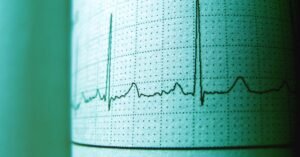 Traçado de eletrocardiograma impresso em papel milimetrado