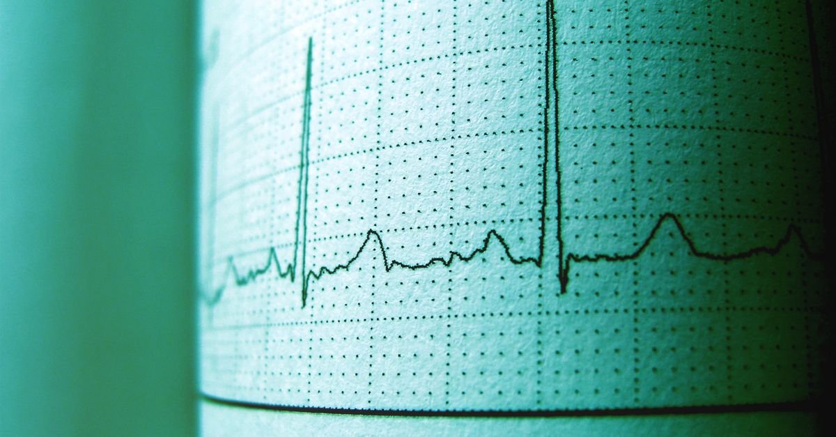 Traçado de eletrocardiograma impresso em papel milimetrado