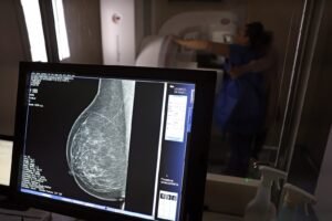Monitor de estação de mamografia digital exibe imagem de exame de mama em unidade de saúde